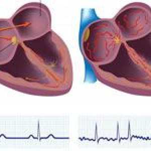 Atrial (intermitent) aritmie cardiacă