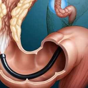 Boala diverticulara a intestinului gros: boala după infecție