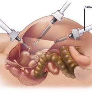 Cum este apendicectomie laparoscopica?