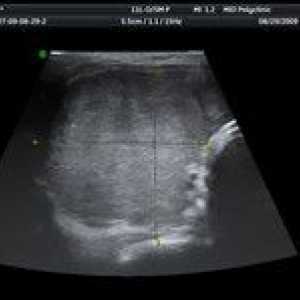 De ce cu ultrasunete a glandei tiroide și arată