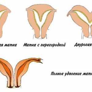 Uter bicorn: structura organelor genitale anomalie
