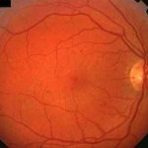 Context eye retinopatia