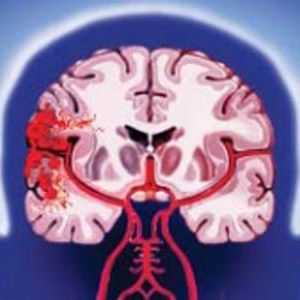 Hemoragică atacul cerebral: tipuri, simptome, diagnostic, tratament, factori de risc