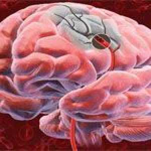 Consecințele accident vascular cerebral ischemic cerebral