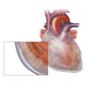 Hydropericardium: aspect, simptome, forma (mici, exprimate) pentru a trata