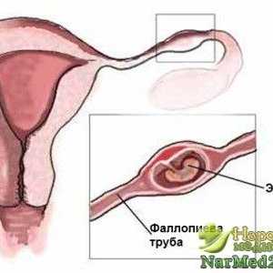 Principalele caracteristici ale diagnostic moderne de sarcină ectopică