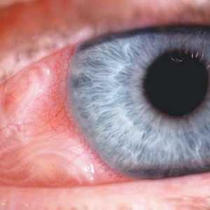 Toxocarioza Ocular: simptome, diagnostic, tratament