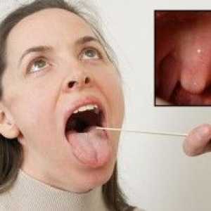 Mufă purulent în gât