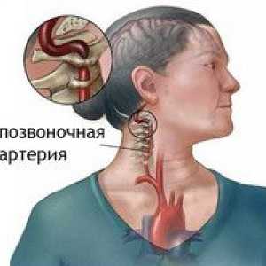 Dureri de cap în osteocondrozei a gâtului