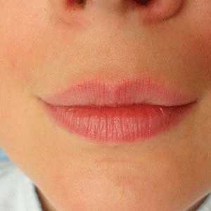 Buzele înainte și după administrarea de acid hialuronic: fotografii și comentarii
