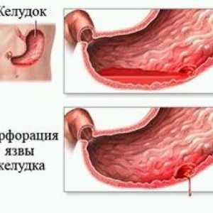 Tratamentul chirurgical al ulcerului gastric perforat