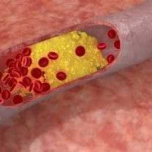 Colesterol în sânge