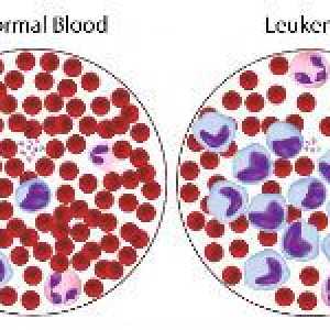 Cum de a trata leucemia sânge