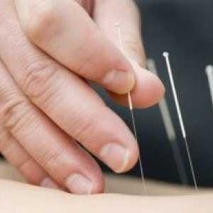 Acupunctura - experienta veche de secole de medicina tradițională orientală