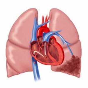 Pulmonare infarct: cauze, simptome, modul de a trata, efectele