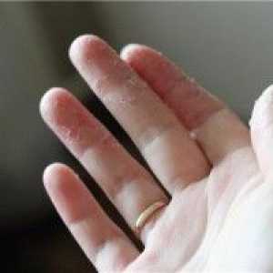 Care este motivul pentru care pielea se desprinde de pe mâinile tale?