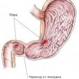 Ulcer gastric și ulcer duodenal: caracteristicile și cauzele