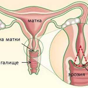 Cauza endocervicosis de col uterin și tratamente