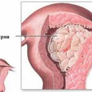 Medicamente eficiente pentru tratamentul fibrom uterin