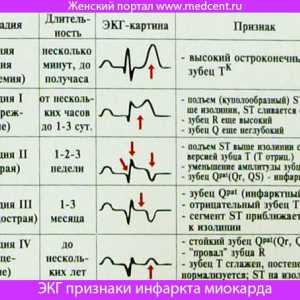 Semne ECG de infarct miocardic. Fotografii și explicații