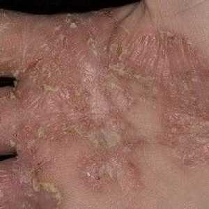 Eczeme pe mâini