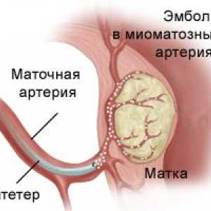Embolizarea fibromului uterin