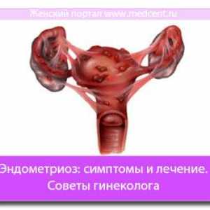 Endometrioza: Simptome si tratament. Sfaturi ginecolog