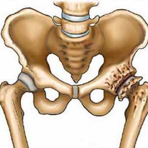 Endoprotezare - Hip înlocuire