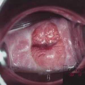 Eroziune de col uterin