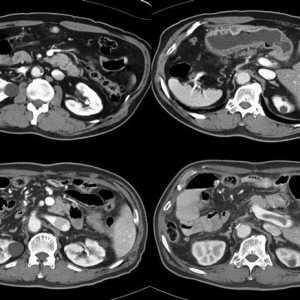 Etapele care se pregătesc pentru CT abdominal cu contrast