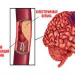Cum de a identifica rapid accident vascular cerebral