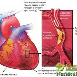 Cum de a trata Heart anginei folosind metode tradiționale