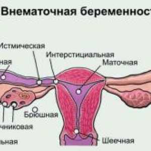 Cum la fața locului semnele unei sarcini extrauterine?
