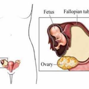 Cum de a identifica o sarcina extrauterina? Simptomele care pot fi identificate în casă