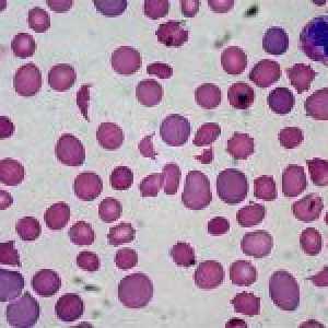 Cauzele leucocite sanguine scăzute