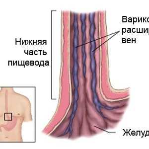 Care sunt simptomele de varice esofagiene și cum să-l trateze