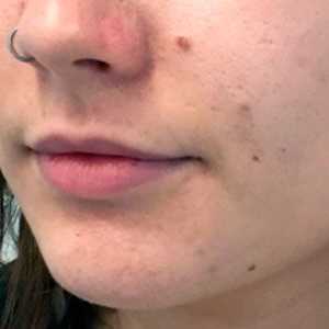 Cum să se adapteze buzele cu ajutorul Botox