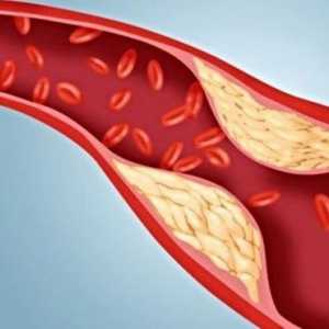 Cum de a reduce nivelul colesterolului din sânge