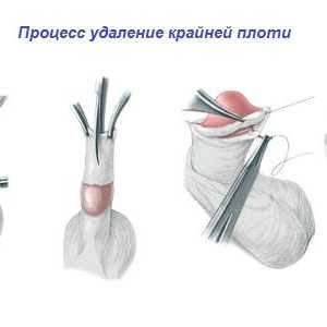 Cum să aibă grijă de organele sexuale dupa circumcizie
