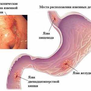 Cum de a vindeca ulcere ale esofagului?