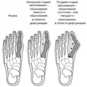 Cum de a vindeca un os la picior: neted și sănătos picior