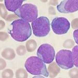 Simptomele de cancer de sânge la adulți și copii