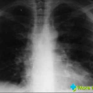Care sunt simptomele de pneumonie: principalele caracteristici ale bolii