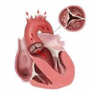 Calcifiere a inimii și a vaselor de sânge: aspectul, caracteristici, diagnostic, tratament