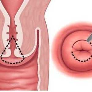 Clasificarea și tratamentul chisturilor pe colul uterin