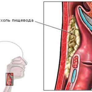 Clasificarea și cauzele cancerului esofagian