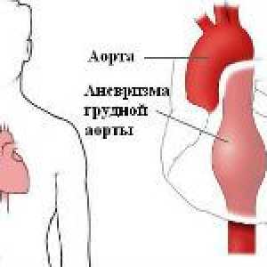 Semnele clinice de anevrism aortic