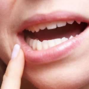 Tratamentul herpesului în gură