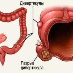 Tratamentul și complicațiile diverticulozei de colon sigmoid