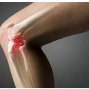 Tratamentul articulației genunchiului după căile de atac prejudiciu populare